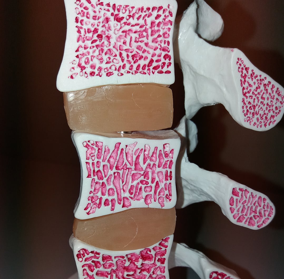 wirbelkoerper osteoporose